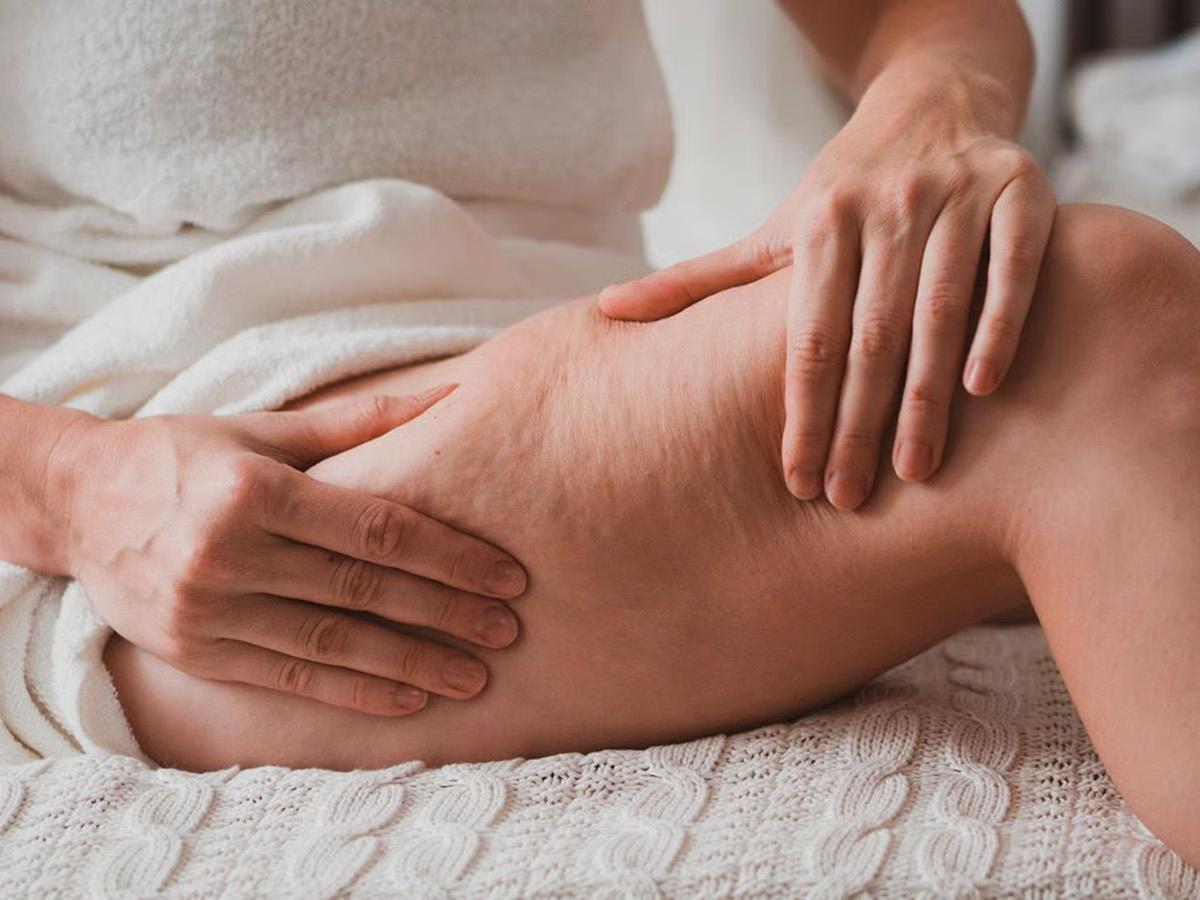 Pelle sensibile e lividi frequenti: campanelli d’allarme del lipedema